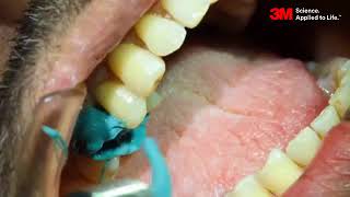 TripleTray technique for posterior Impressions using 3M Monophase [upl. by Neveda]