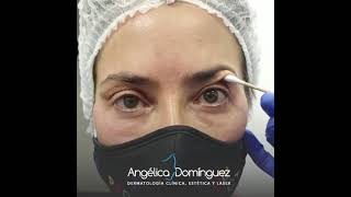 Blefaroplastia Sin Cirugía  Dr Angélica Domínguez Dermatóloga en bogotá [upl. by Aicerg]