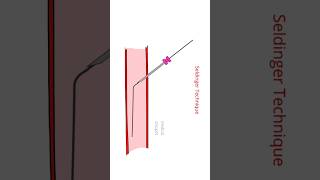 Seldinger Technique injection mbbs medicalsnippet Seldinger artery [upl. by Sykes]