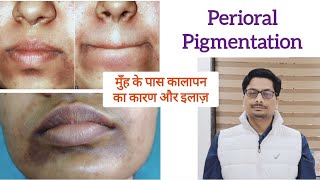 मुँह के पास कालापन का कारण और इलाज़ Perioral Pigmentation pigmentationtreatmentathome pigmentation [upl. by Anya]