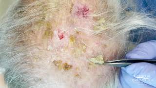 Debulking Lesions on the Scalp Erosive Pustulosis of the Scalp  CONTOUR DERMATOLOGY [upl. by Werbel]