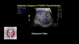 Bethesda Category IV FNSFN Thyroid Nodule Video  Thyroid Ultrasound Video Atlas [upl. by Arretahs]