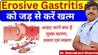 Erosive Gastritis A Comprehensive Guide to Causes Symptoms and Treatmentdrramakantsharma7 [upl. by Mcnamee]