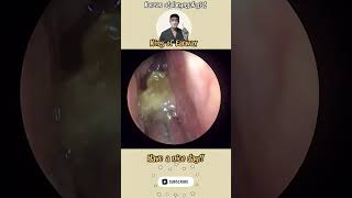 귀지형 콧물 부비동염 축농증 비염 코청소 이비인후과 rhinorrhea rhinitis sinusitis asmr ENT ENTdoctor [upl. by Bovill637]