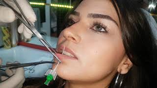 Labret  Dudak  Piercing Deldirme Sonrası İlk Değişim [upl. by Kcirderfla283]