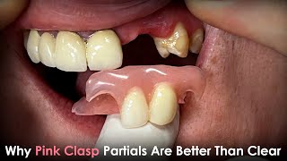 Why Pink Clasp Partials Are Better Than Clear Clasp Partials [upl. by Asilec]