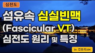 섬유속 심실빈맥fascicular VT fascicular ventricular tachycardia 심전도ecg 이해 [upl. by Hcurob]