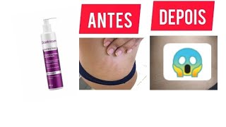 COMO PREVENIR ESTRIAS  CREME CICATRICURE FUNCIONA MESMO  Antes x Depois 😱 [upl. by Halika273]