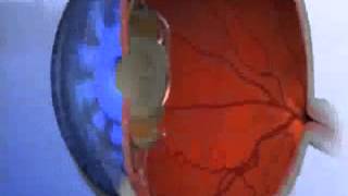 Multifocal Intraocular Lens How Does It Work [upl. by Anaiq]