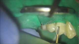 CEREC Crown Removed using the Forrest Tech [upl. by Einnaffit]