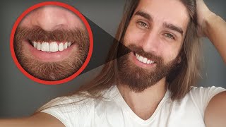 ANTES E DEPOIS DO DENTISTA  7 ANOS DE APARELHO [upl. by Rebmyk261]