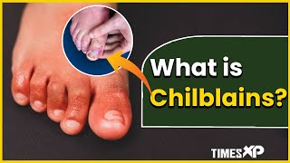 Chilblain What Is it Causes amp Rashes Itching Inflammation On The Skin  TimesXP [upl. by Refynnej]