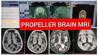 Propeller Brain MRI scan protocol positioning and planning on GE 15 Tesla [upl. by Albion]