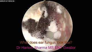 Ear Fungus  Otomycosis [upl. by Clint485]