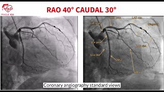 Coronary angiography standard views [upl. by Fotina538]