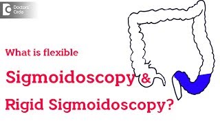 Rigid vs Flexible Sigmoidoscopy  Dr Rajasekhar M R [upl. by Damita]