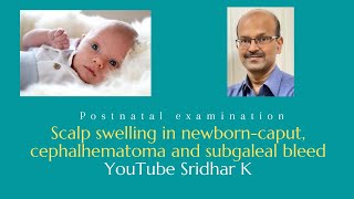 Scalp swelling in newborn period caput cephalhematoma subgaleal bleed Dr Sridhar K [upl. by Azeria182]