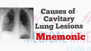 Cavitary lung lesion [upl. by Josepha]