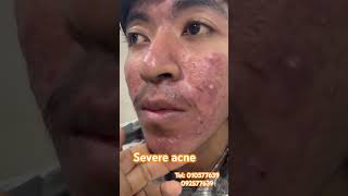 Severe acne treatment by Dr makara [upl. by Airehc]