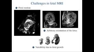 MICCAI 2015  Automated Localisation of the Heart Lungs and Liver in Fetal MRI [upl. by Lussi]