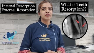 What is Teeth Resorption External amp Internal Resorption kya hota hai Dr Jyoti Agarwal [upl. by Evaleen]