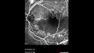 Proliferative Diabetic Retinopathy [upl. by Nahamas]