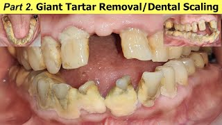 Part 2  Dental Cleaning amp Massive Tartar Removal I पायरिया का इलाजI Dr Ram MDS New Delhi [upl. by Swane]