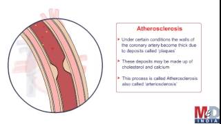 Coronary Artery Bypass Surgery [upl. by Egarton]