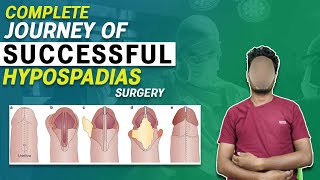 Successful Hypospadias Surgeon in Kolkata  मूत्र का छिद्र सही जगह पर न खुलने की समस्या  Dr Nagwani [upl. by Anwaf474]