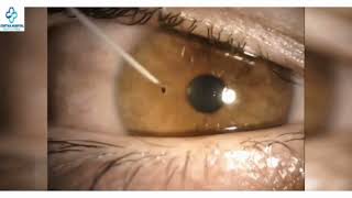 Corneal foreign body removal hospital pune pcmc chinchwad medical medicalservices foreignbody [upl. by Elli856]