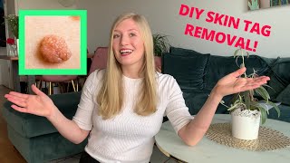 DIY Skin Tag Remover REVIEW [upl. by Beckerman465]