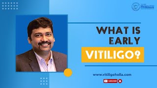 Early vitiligo  Symptoms and treatments  Dr A P Holla  MelanoSite [upl. by Justinian]