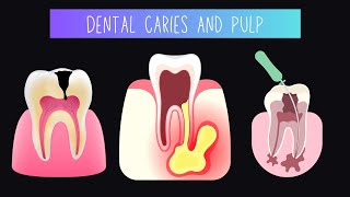 Dental caries and pulp [upl. by Stasny928]