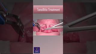 Tonsillitis Treatment With Heat Device tonsillitis [upl. by Kyla316]