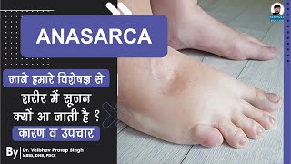 What is Anasarca   Causes Symptoms and Treatment  शरीर में सूजन क्यों आ जाती है [upl. by Cima717]