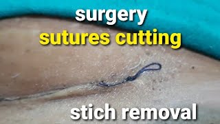 Stiches removal and dressing after cesarean section  घुलनशील टाँको को काटना  suture removal [upl. by Ahsinauj]