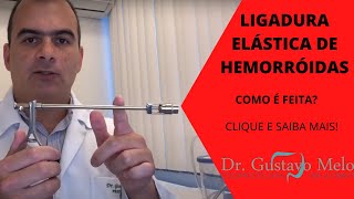 Tratamento de hemorróidas SEM CIRURGIA A ligadura elástica Como ela é feita [upl. by Girardi]