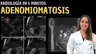 Radiología en 5 minutos Adenomiomatosis [upl. by Jeromy]