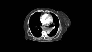 Angiotomografia Arteria pulmonar Protocolo para TEP TROMBOEMBOLISMO PULMONAR Adquisición Axial [upl. by Janeta]