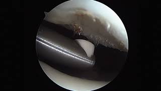 Arthroscopic Chondral Debridement Using Radiofrequency [upl. by Bui]