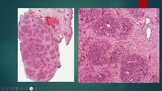 2024 09 16 Lobular Capillary Hemangioma Pyogenic Granuloma [upl. by Ehttam]