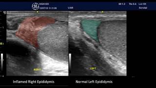 Acute Epididymitis  some PointofCare Ultrasound Features [upl. by Limaj]