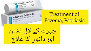 Advantan cream Advantan cream uses Advantan cream benefits in urdu Skin Inflammation ka Ilaaj [upl. by Amsab]