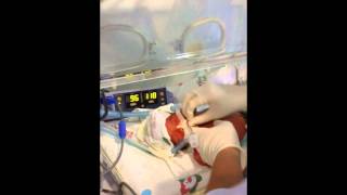 Neonatal Digital intubation by a First Year Fellow [upl. by Rehpotsirhcnhoj667]