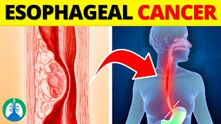 Top 10 Early Warning Signs of Esophageal Cancer  NEVER Ignore THIS [upl. by Macegan210]