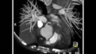 Type B dissection with compression of true lumen [upl. by Uolyram]