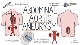 Understanding Abdominal Aortic Aneurysms [upl. by Nhguav]