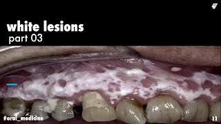 white lesions  leukoplakia 2  oral medicine  عزت شومان [upl. by Ahsyat]