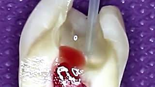 Pulpotomy Procedure This is How Tooth is Cleaned and Prepared for Dental Cavity  Tooth Filling [upl. by Aihtnys]