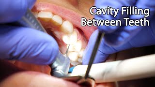 Dentist Filling A Cavity Between Teeth [upl. by Shipman]